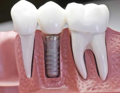 Three teeth with one tooth implant